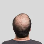 Hair Loss Advisor